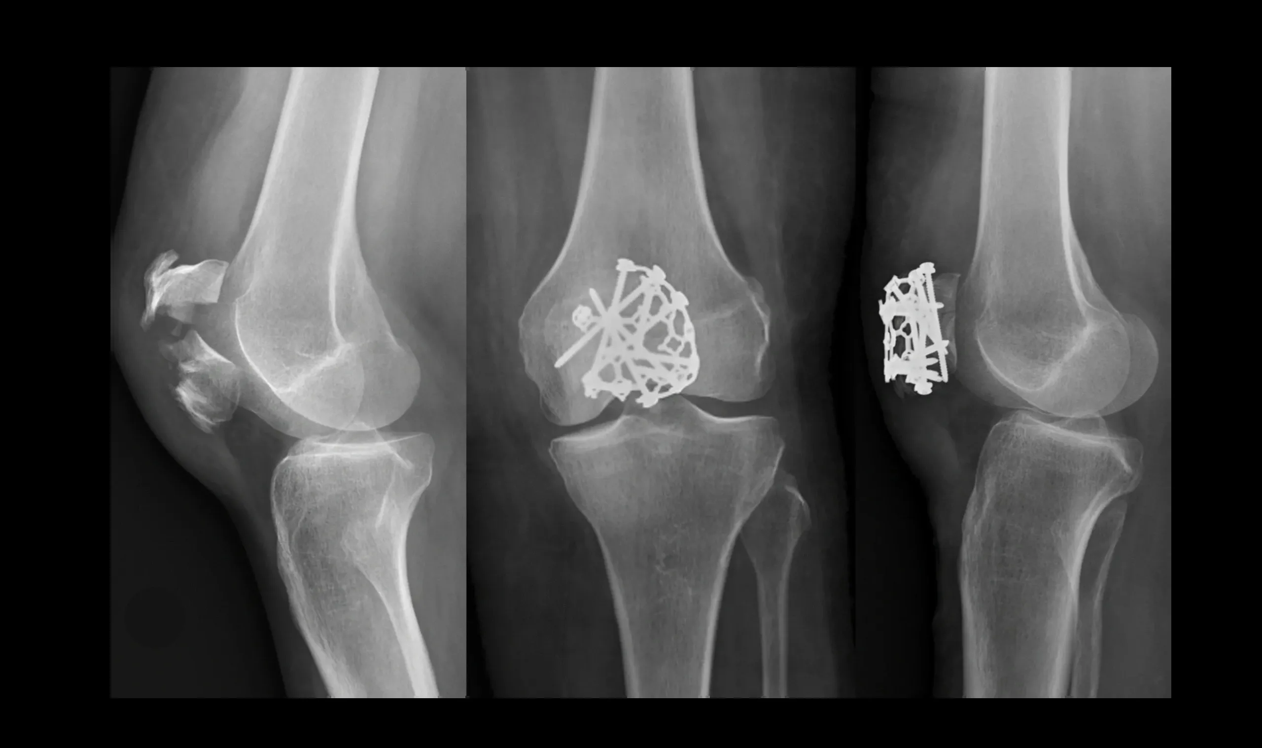 Radiografías de rodilla