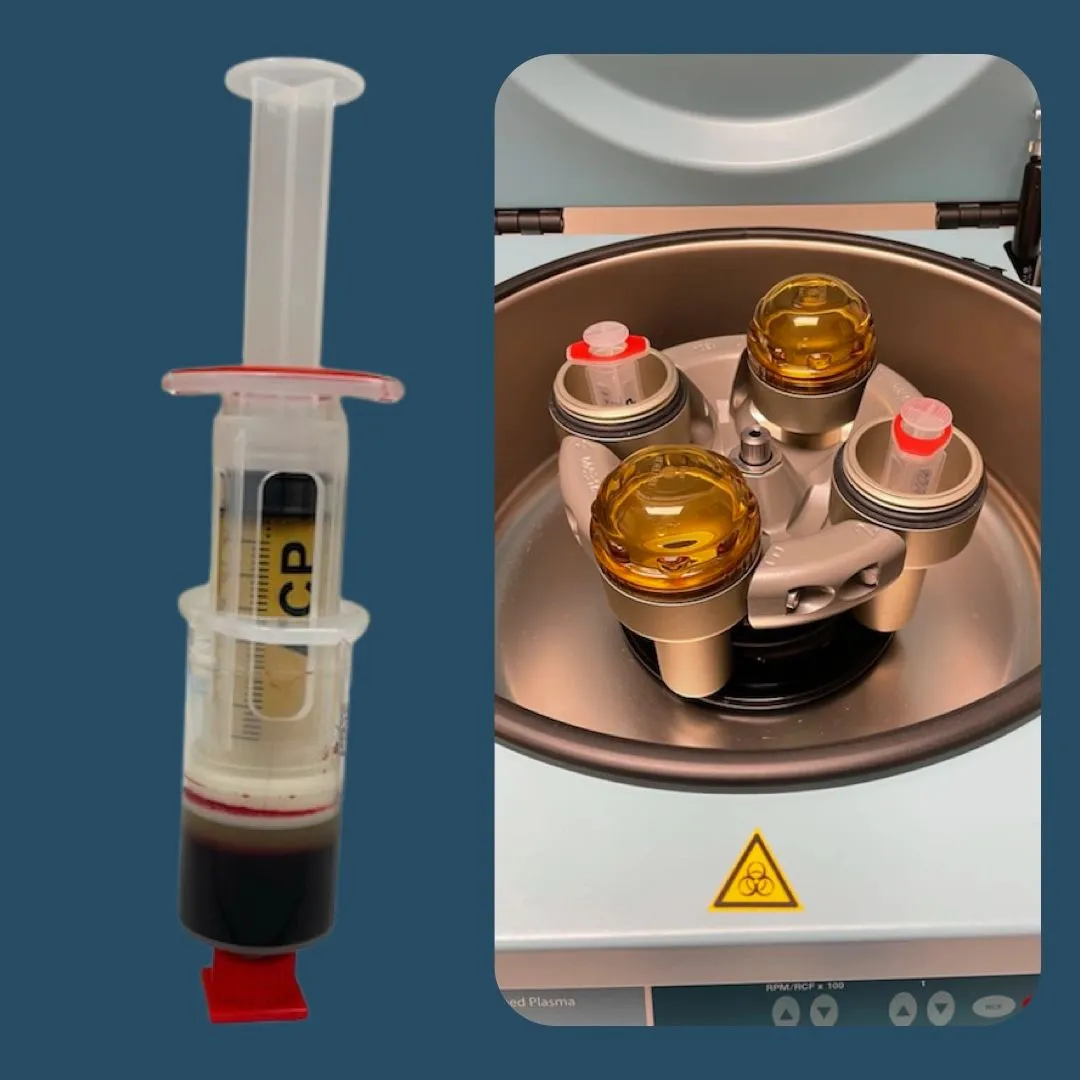 Preparación de plasma rico en plaquetas (PRP) con jeringa y centrífuga